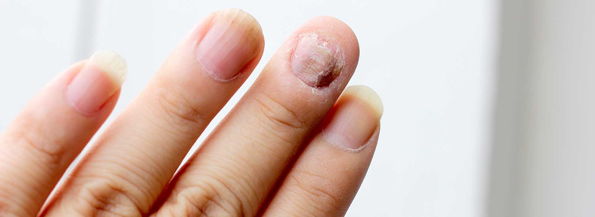 Mycose des ongles de pied : cause et traitement